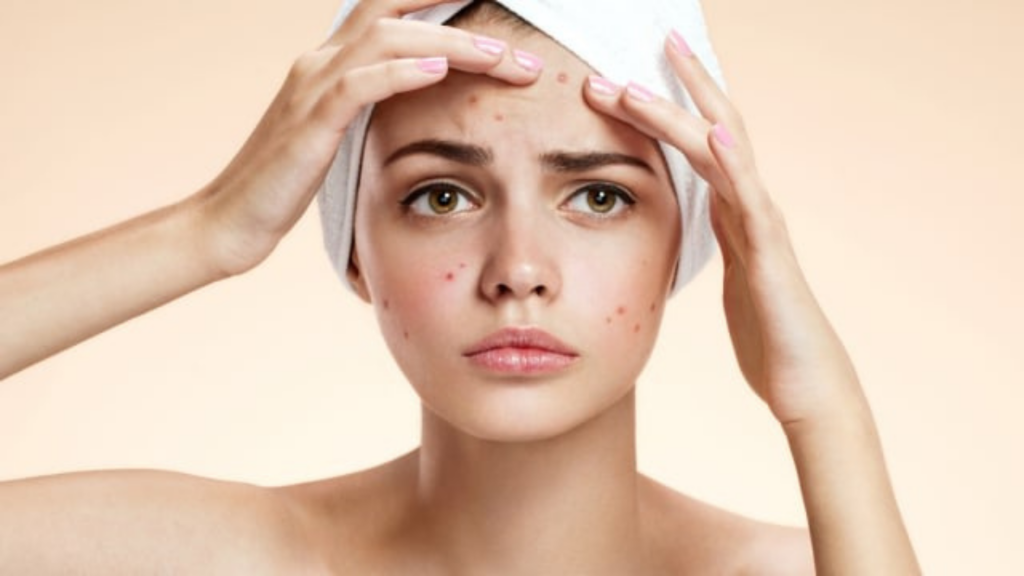 фото: дівчина з висипаннями на шкірі – вплив кортизолу на шкіру